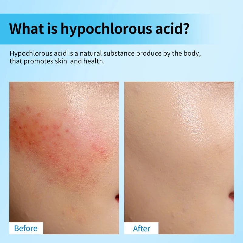 Hypochlorous Acid Facial Mist for Skin Hydration and Calming - 65ml