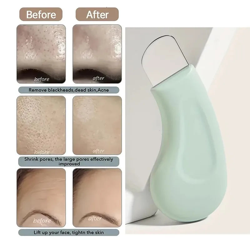Blackhead and Whitehead Removal Tool for Nose and Face - Skin Pore Cleaner for Women