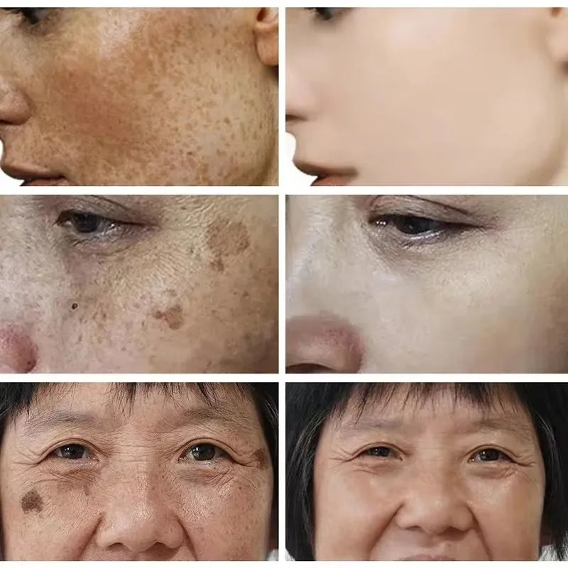 Whitening Freckle Cream for Face Brightening & Melasma Reduction - Niacinamide Skin Care