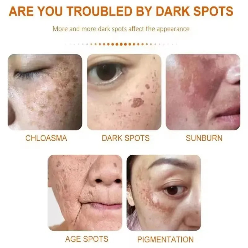 Whitening Freckle Cream for Face Brightening & Melasma Reduction - Niacinamide Skin Care