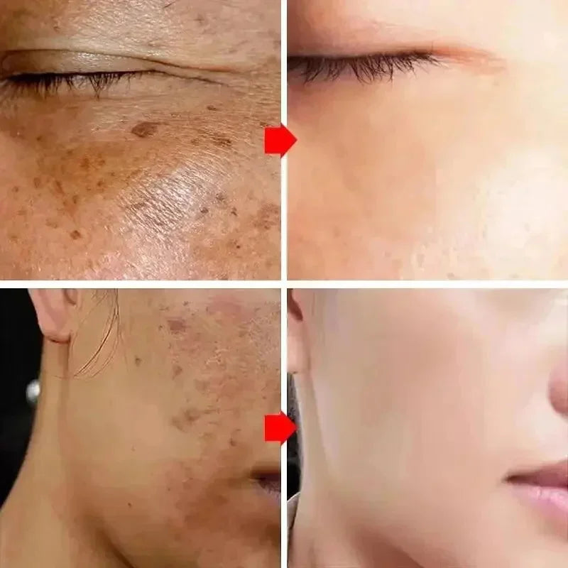 Spot-Removing Brightening Face Cream for Melasma Dark Spots - Multiple Colors