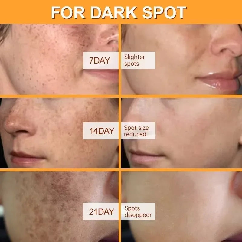 Whitening Face Cream for Dark Spots & Melasma - Brightening Skin Care 20g