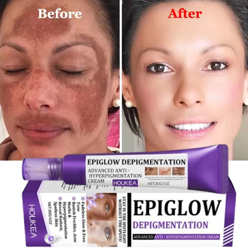 Freckle Whitening Cream for Dark Spots Melasma Skin Brightening & Hydration