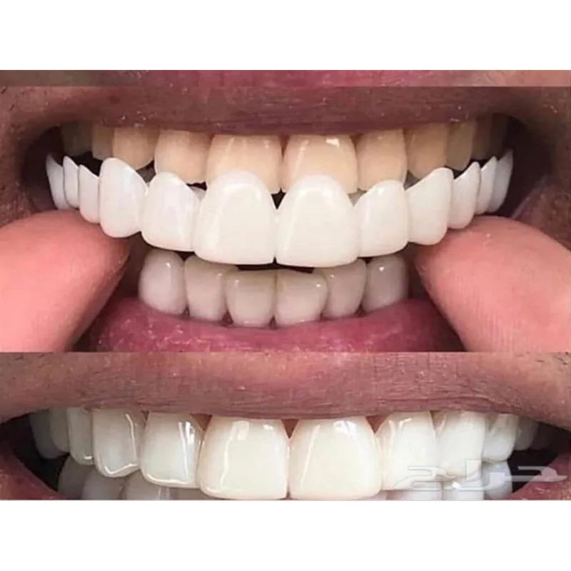 Silicone Dental Veneers Set for Upper and Lower Teeth - Fake Smile Cover