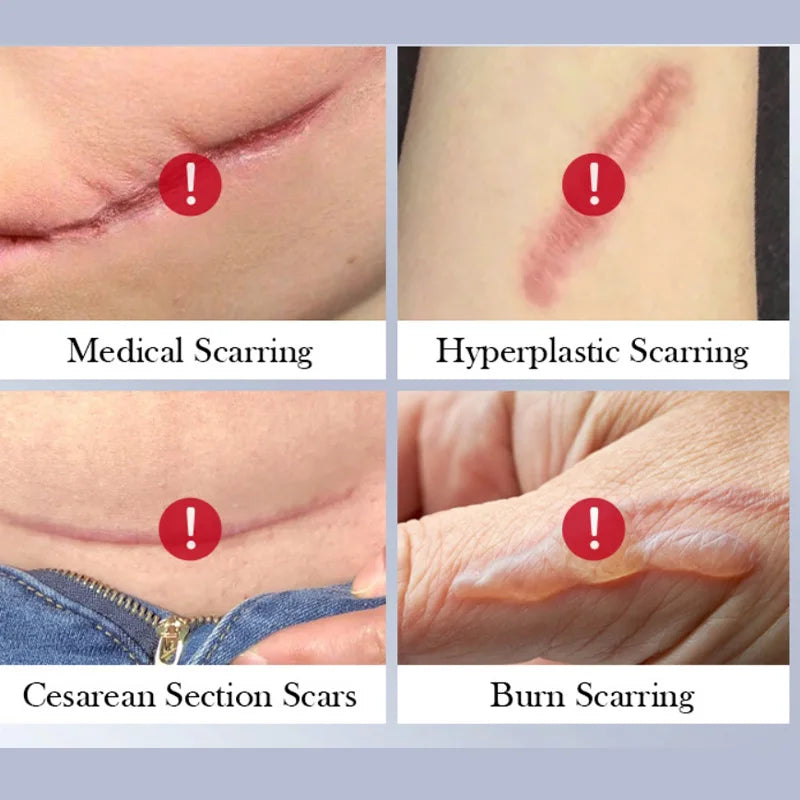 Scar Repair Cream for Skin Wounds and Scars - Moisturizing Rejuvenating Gel