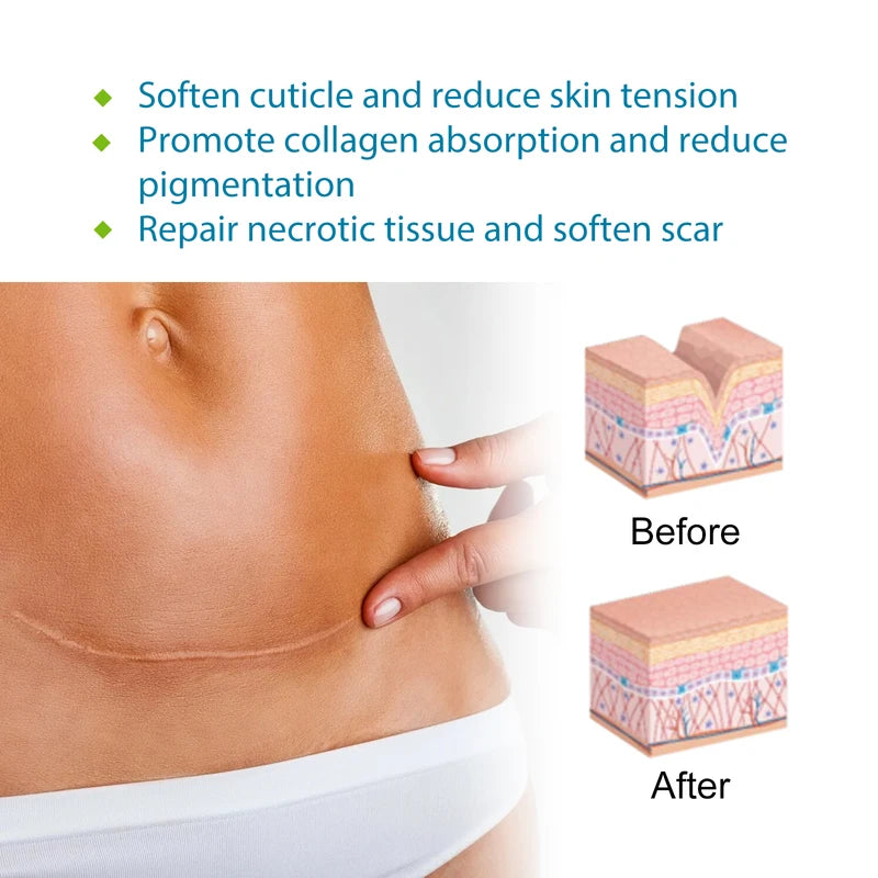 Reusable Silicone Scar Sheets for Surgical & Hypertrophic Scars - Medical Grade, Custom Fit