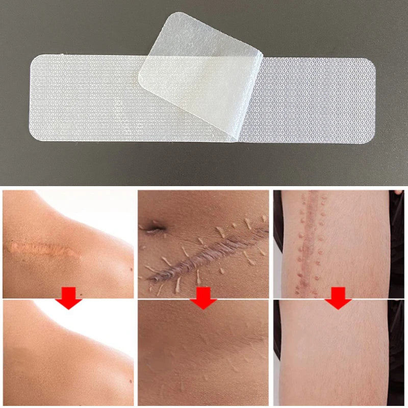 Silicone Scar Removal Patches - 4 Pack 15cm Wound & Burn Scar Tape