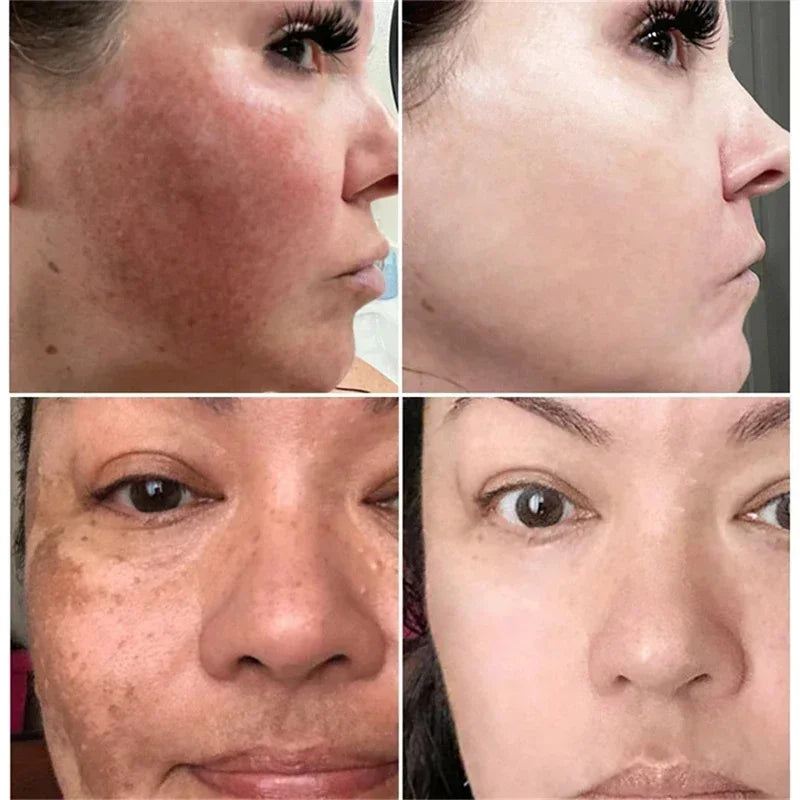 Whitening Face Cream for Dark Spots & Melasma - Brightening Skin Fast
