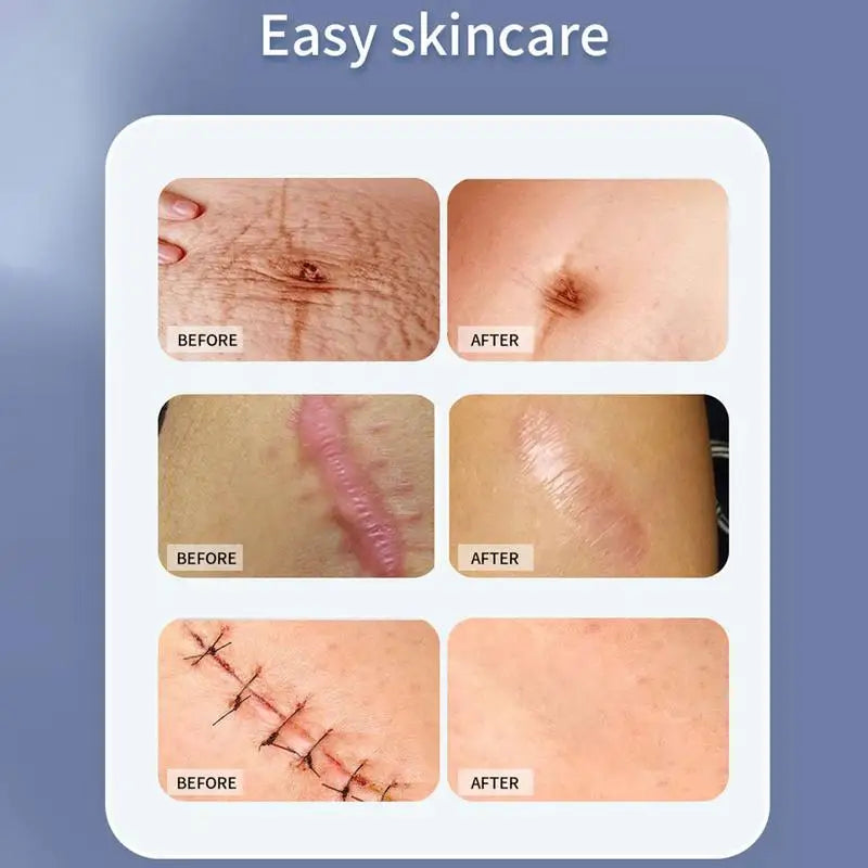 Self-Adhesive Silicone Scar Tape - Reusable Skin Care Strips for Scar Reduction 4x50cm