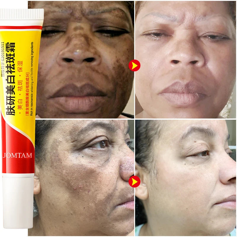Whitening Freckle Cream for Face Brightening & Melasma Reduction - Niacinamide Skin Care