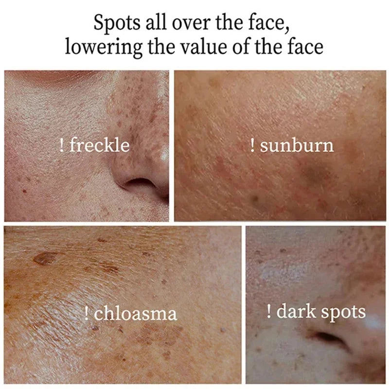 Whitening Face Cream for Dark Spots & Melasma - Brightening Skin Fast