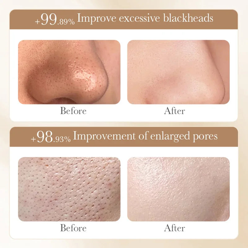 White Rice Peeling Mask for Blackhead Removal & Acne - Moisturizing Facial Peel-off