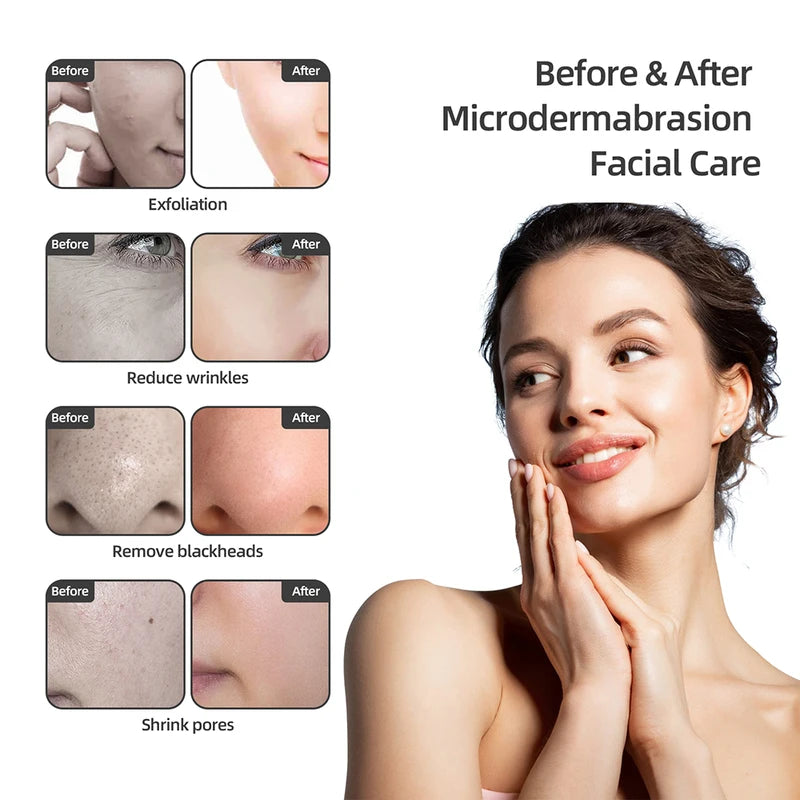 Deep Cleansing Facial Peeling Device for Skin Care & Pore Refinement