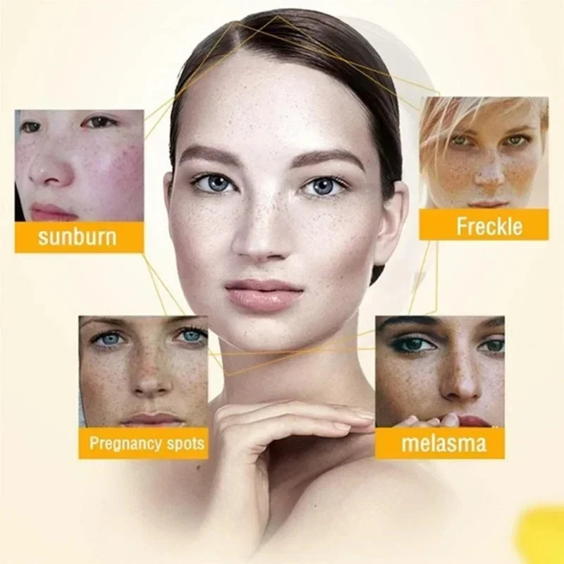 Whitening Freckle Cream for Dark Spot Removal & Brightening - 20g