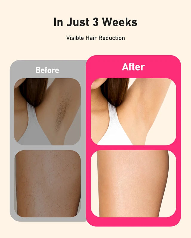 IPL Hair Removal Device with 999999+ Flashes for Face & Body - Painless & Permanent