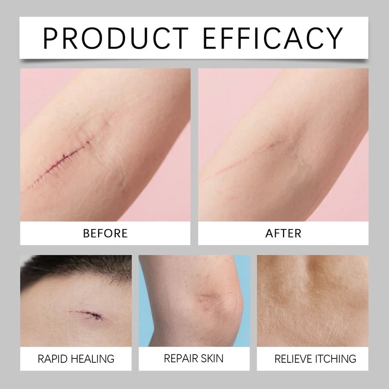 Portable Silicone Scar Stick for Face & Body Skin Repair, Reduce Allergies