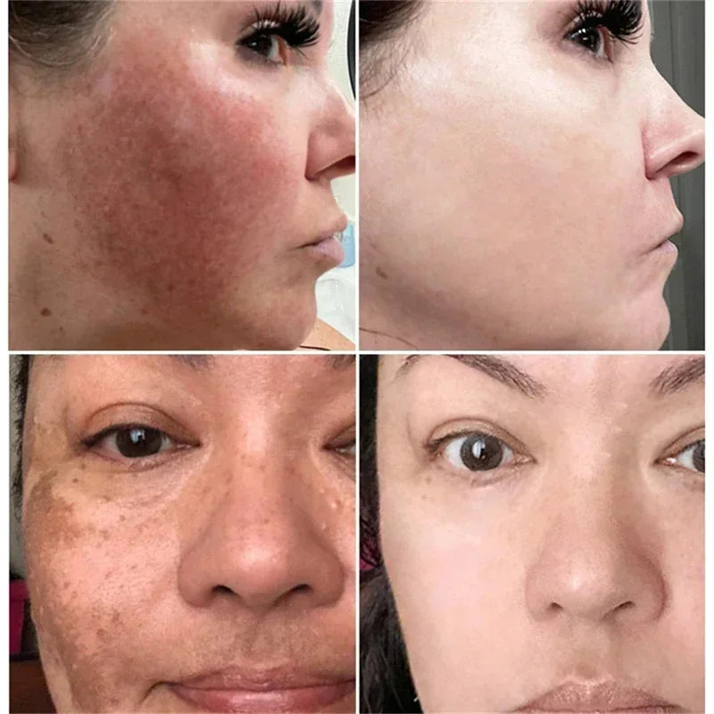 Brightening Spot-Removing Skin Cream for Melasma Dark Spots & Pigmentation - All Colors