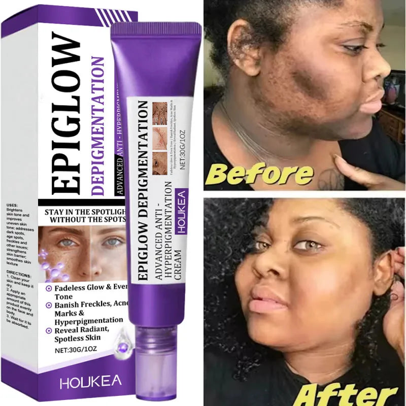 Freckle Whitening Cream for Dark Spots Melasma Skin Brightening & Hydration