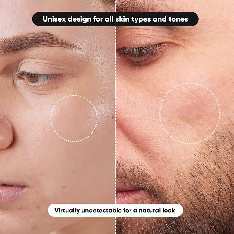 Waterproof Acne Patch Set for Facial Cleansing - Hypoallergenic, All Skin Types