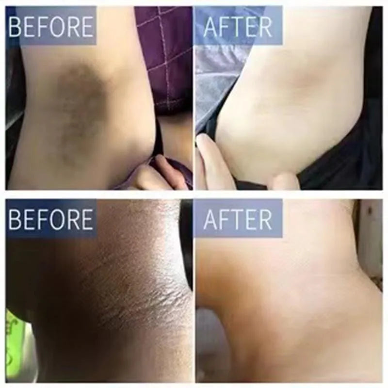 Body Whitening Cream for Dark Skin - Melanin Removal & Brightening Lotion