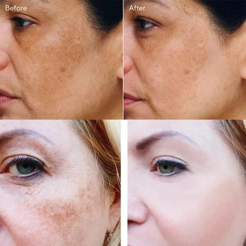 Powerful Skin Brightening Cream for Melasma Dark Spots & Pigmentation Removal - Korean Skin Care