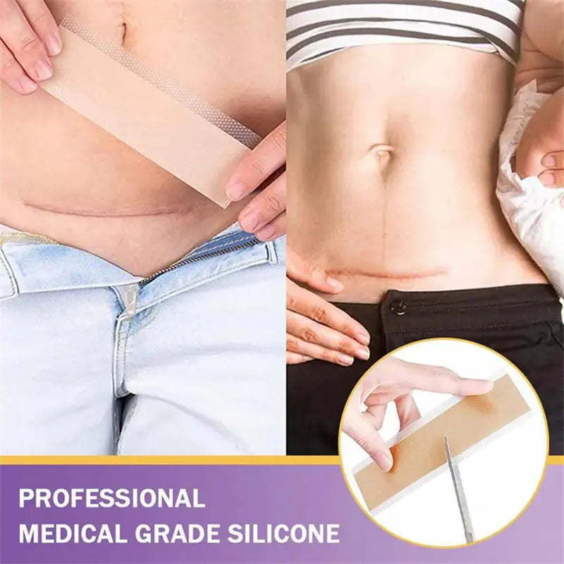 Silicone Scar Removal Patch - Gentle, Breathable Skin Repair Tape for Keloid, Burn & Trauma Scars