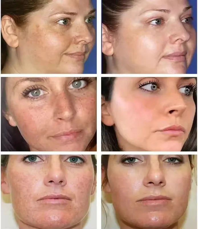 Freckle Whitening Cream for Dark Spots Melasma Skin Brightening & Hydration