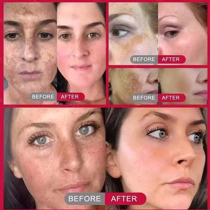 Spot-Removing Brightening Face Cream for Melasma Dark Spots - Multiple Colors