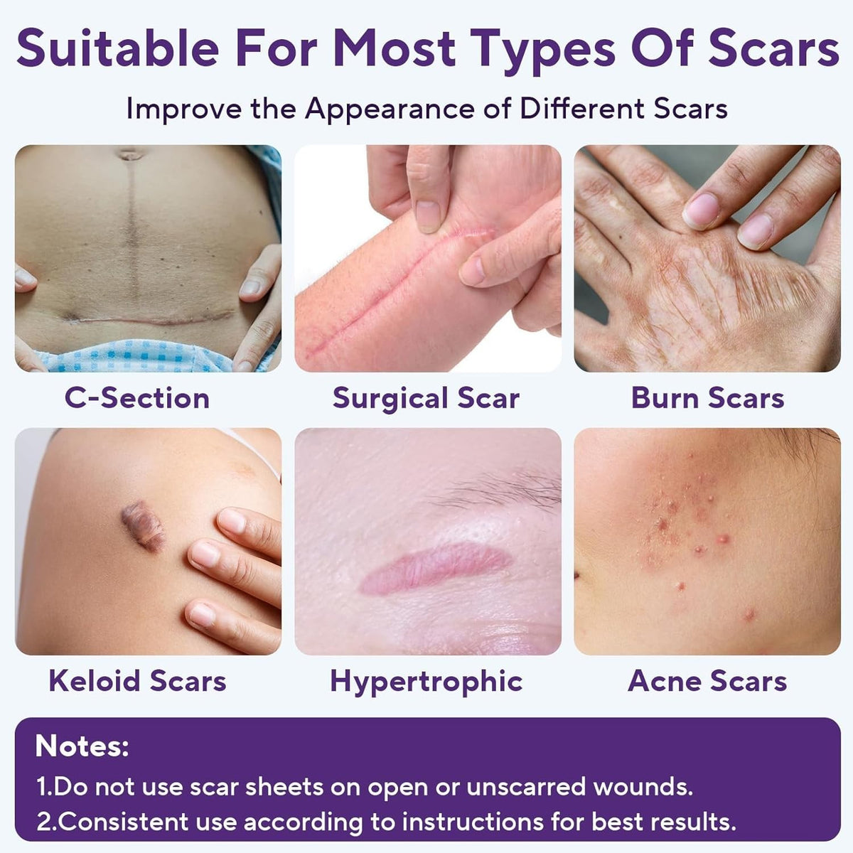 Silicone Scar Removal Tape for Hypertrophic Scars & Keloids - 1.6" x 60" Reusable Strip