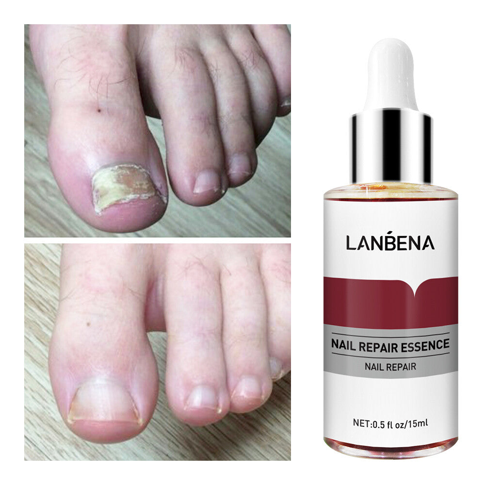 Ginger Antibacterial Nail Treatment Serum for Fungal Repair - 2PCS