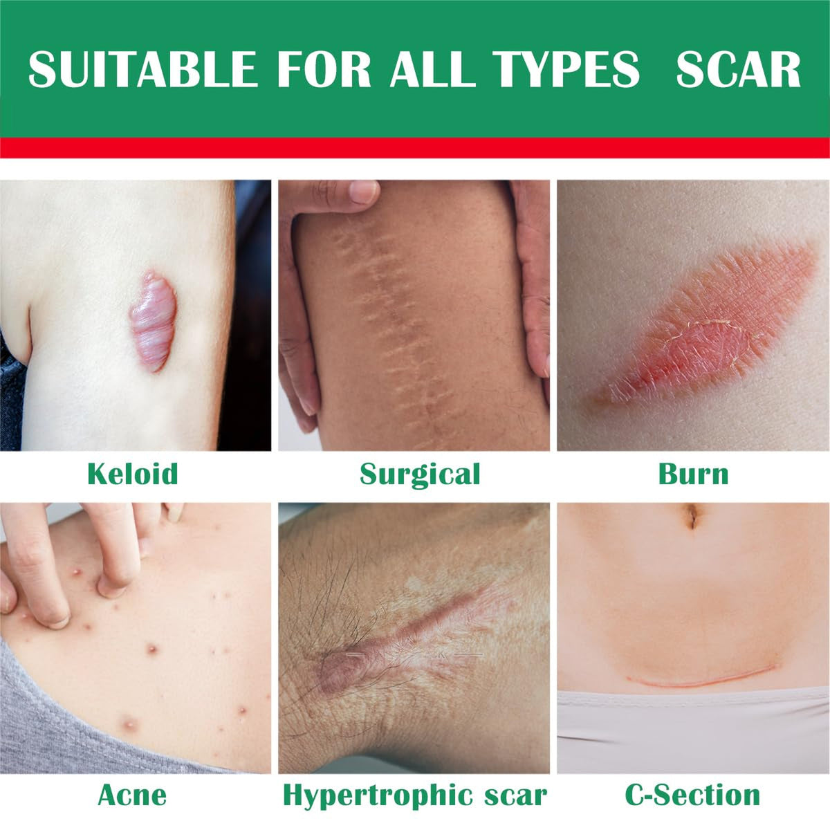 Silicone Scar Gel for Old & New Scars, Stretch Marks & Skin Healing - 1oz