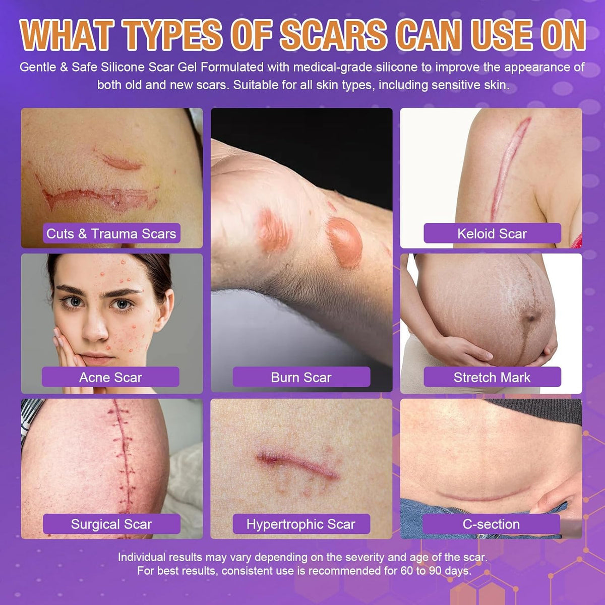 Silicone Scar Gel for Keloid & Surgical Scar Removal - Acne & Burn Marks Treatment