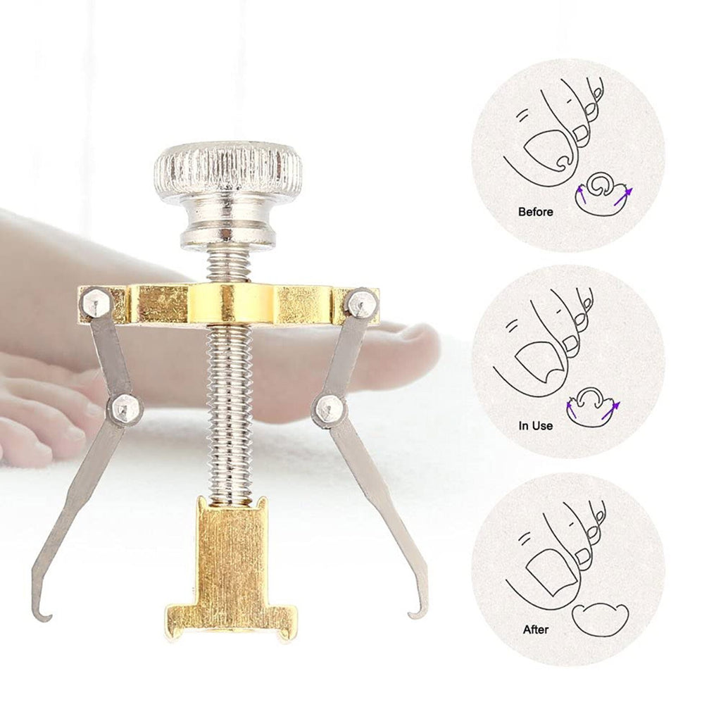 Ingrown Toenail Correction Lifter Tool - Nail Straightener & Paronychia Fixer
