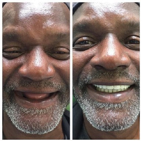 DIY Partial Denture Kit for At-Home Custom Dentures with Shades & Instructions