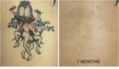 Permanent Tattoo Removal Cream – Pain-Free, Maximum Strength, Safe for 6+ Months Supply
