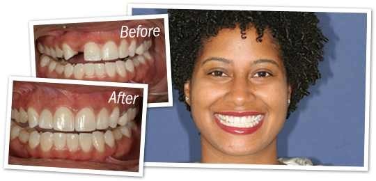 Temporary Teeth Repair Kit - Cosmetic Tooth Replacement, 30 Teeth, Safe & Natural-Looking