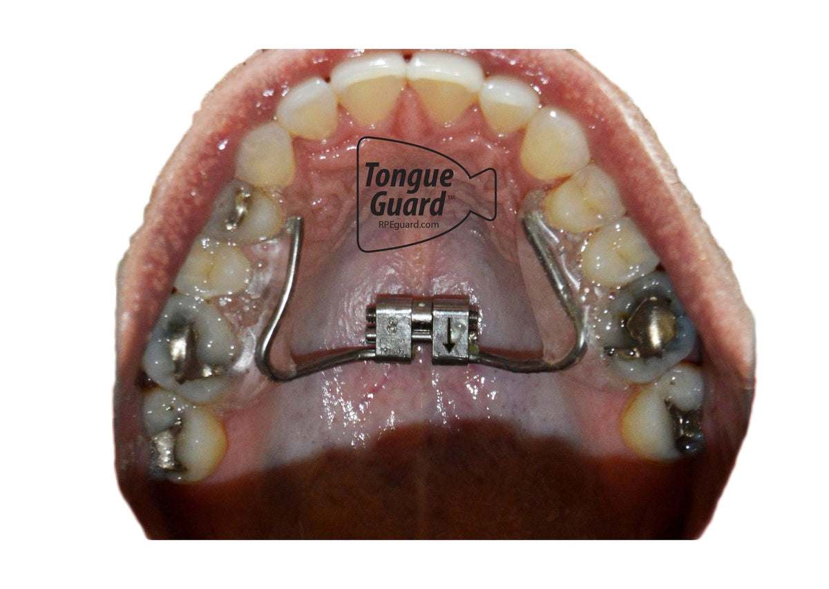Tongue Guard for Dental Expanders - Prevents & Heals Tongue Sores, Custom Fit, 3 Trays