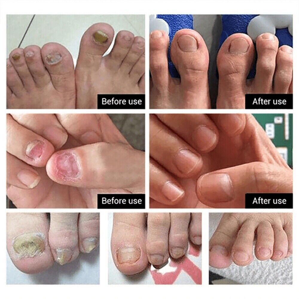 Ginger Antibacterial Nail Treatment Serum for Fungal Repair - 2PCS