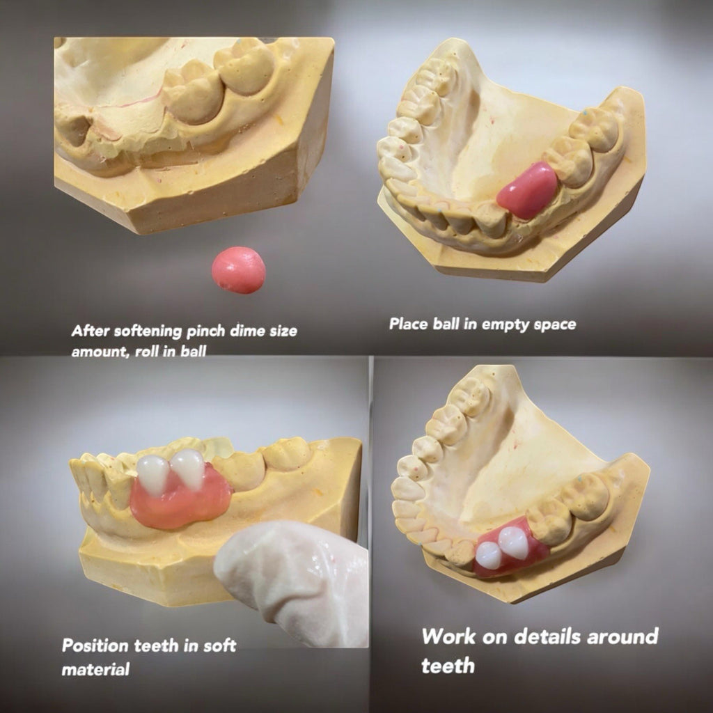 Partial Denture Kit - Make Custom Temporary Teeth A2, Reusable & Easy
