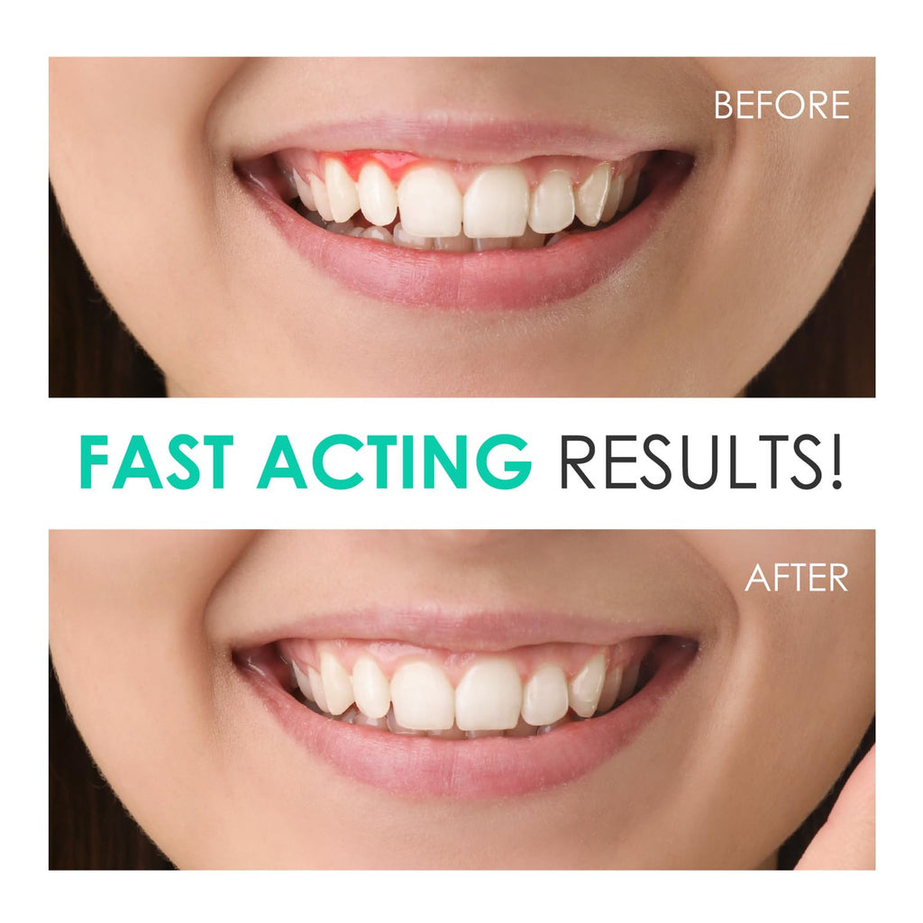 Gum Disease Treatment Oral Cleansing Gel with Trays - 1.7% Hydrogen Peroxide