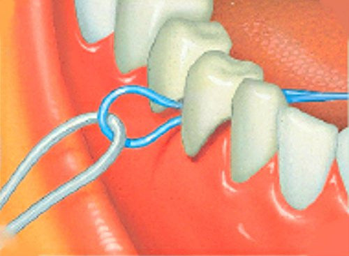 Dental Floss Threaders Pack for Bridges and Braces - 10 Count