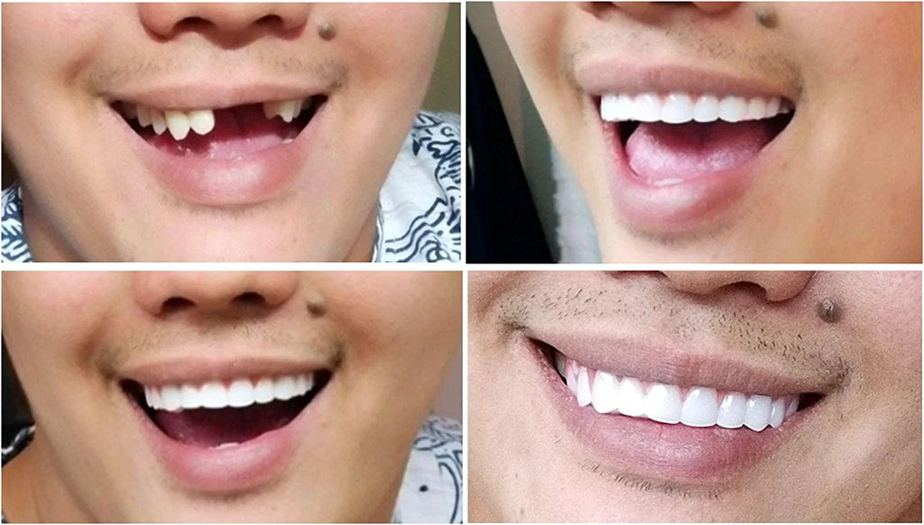 Bright White Upper Veneer Cosmetic Teeth - Flex Fit Press-On Smile