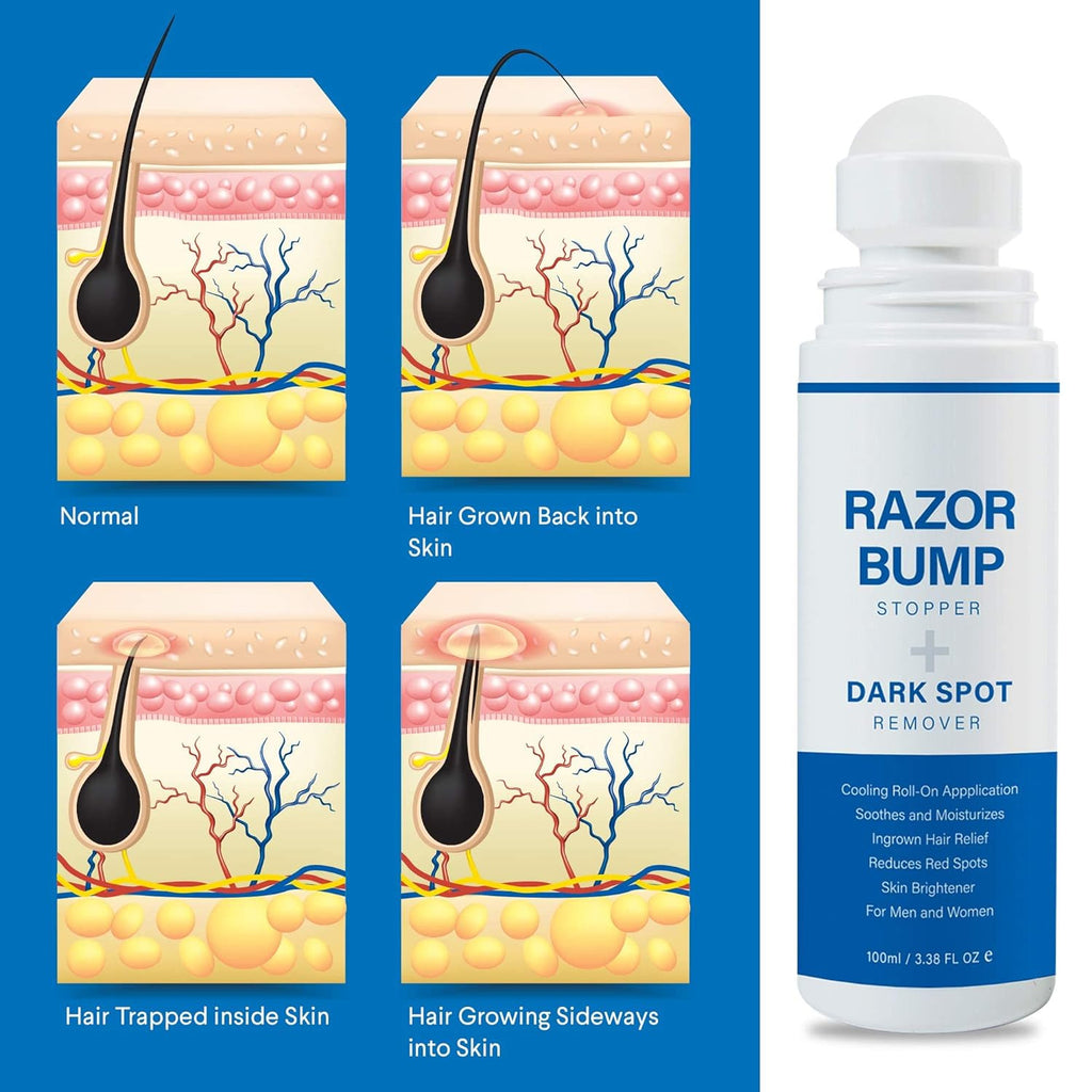 Razor Bump Stopper with Ingrown Hair Treatment for Men and Women - Roll-On Serum for Shaving Irritation, Redness, and Dark Spots, 3.38 Fl Oz