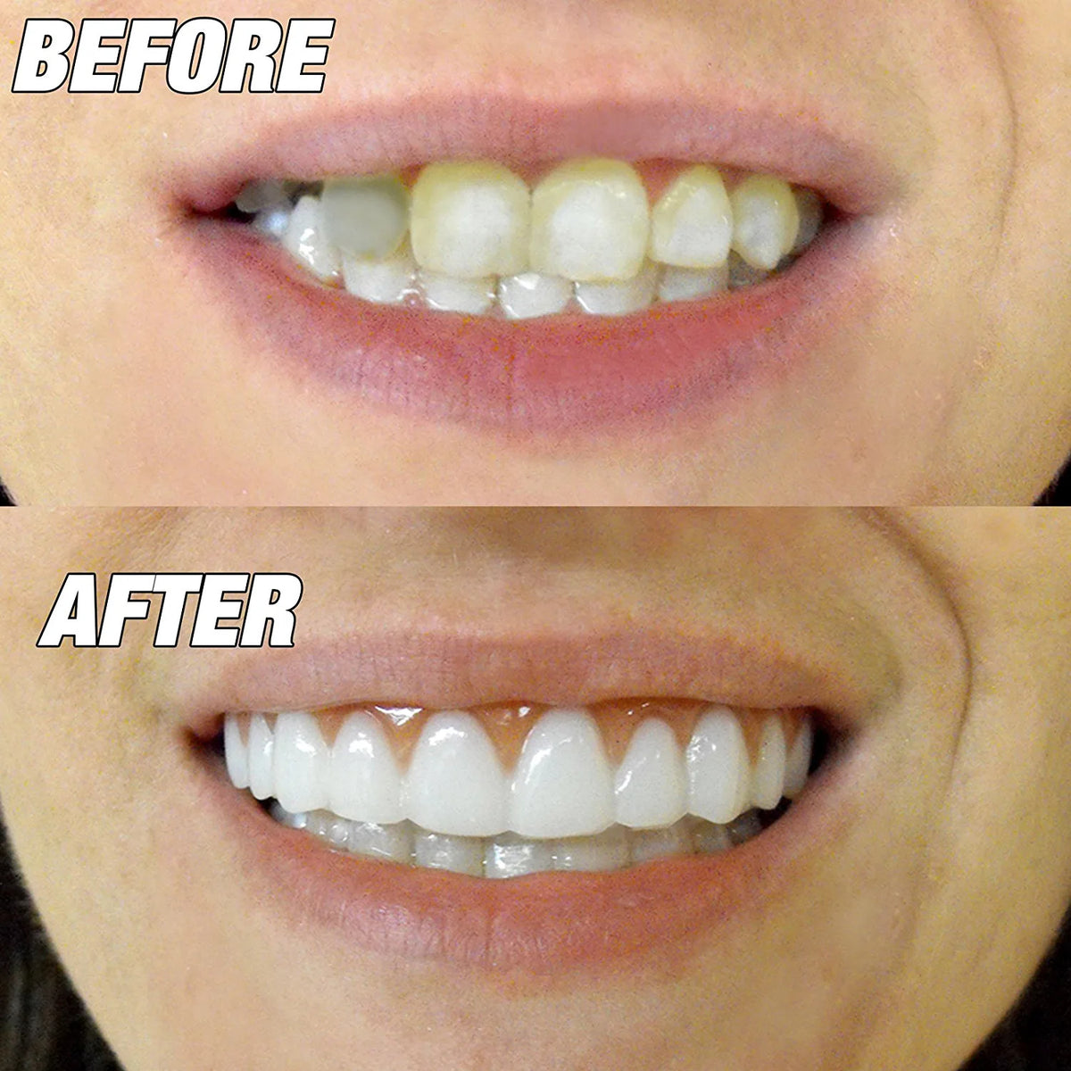 Bright White Upper Veneer Cosmetic Teeth - Flex Fit Press-On Smile