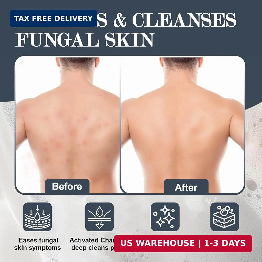 Antifungal Soap with Tea Tree Oil, Charcoal & Volcanic Ash - 3 Bars