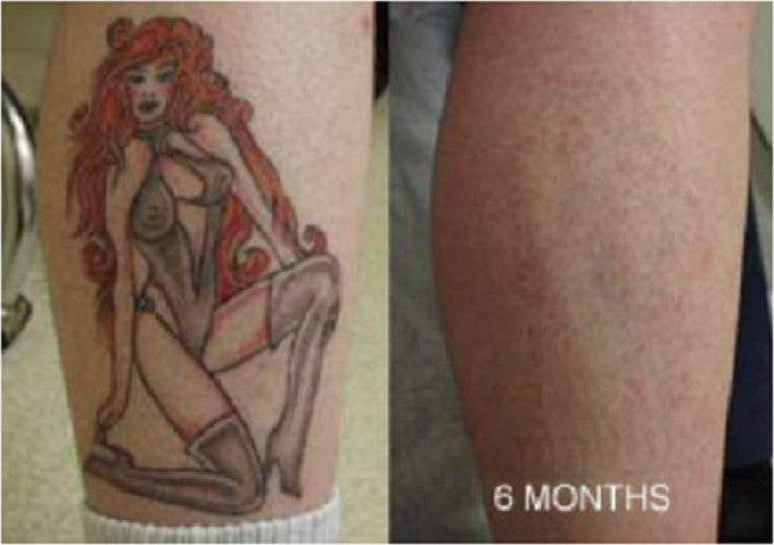 Tattoo Removal Cream - Maximum Strength Fade & Moisturize