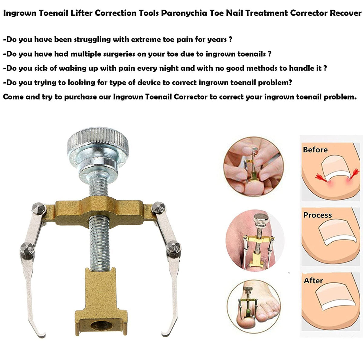 Ingrown Toenail Correction Lifter Tool - Nail Straightener & Paronychia Fixer