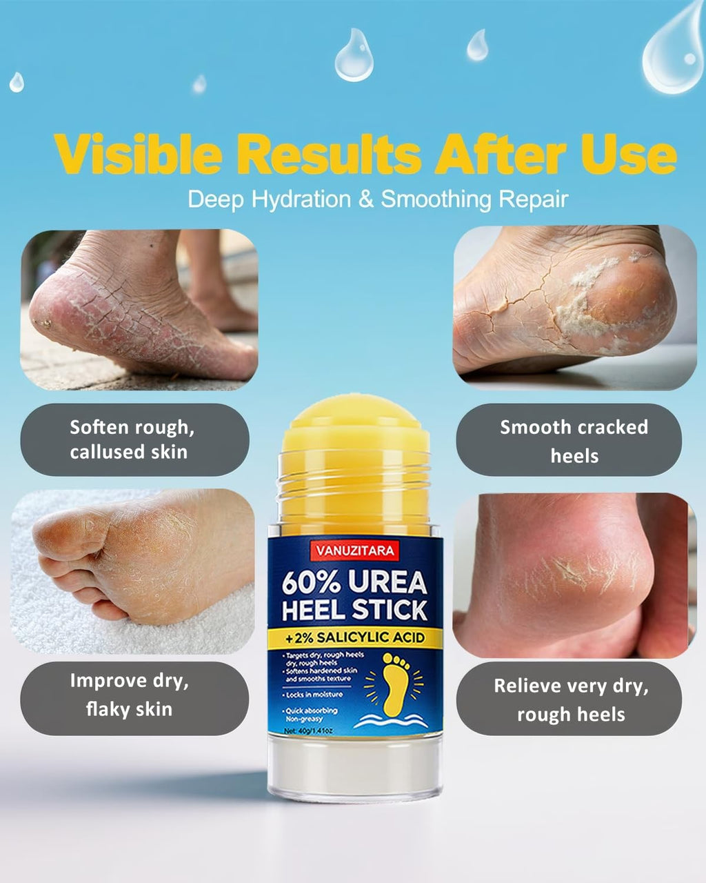 Urea Foot Cream Stick 60% with Salicylic Acid for Cracked Heels & Dry Skin