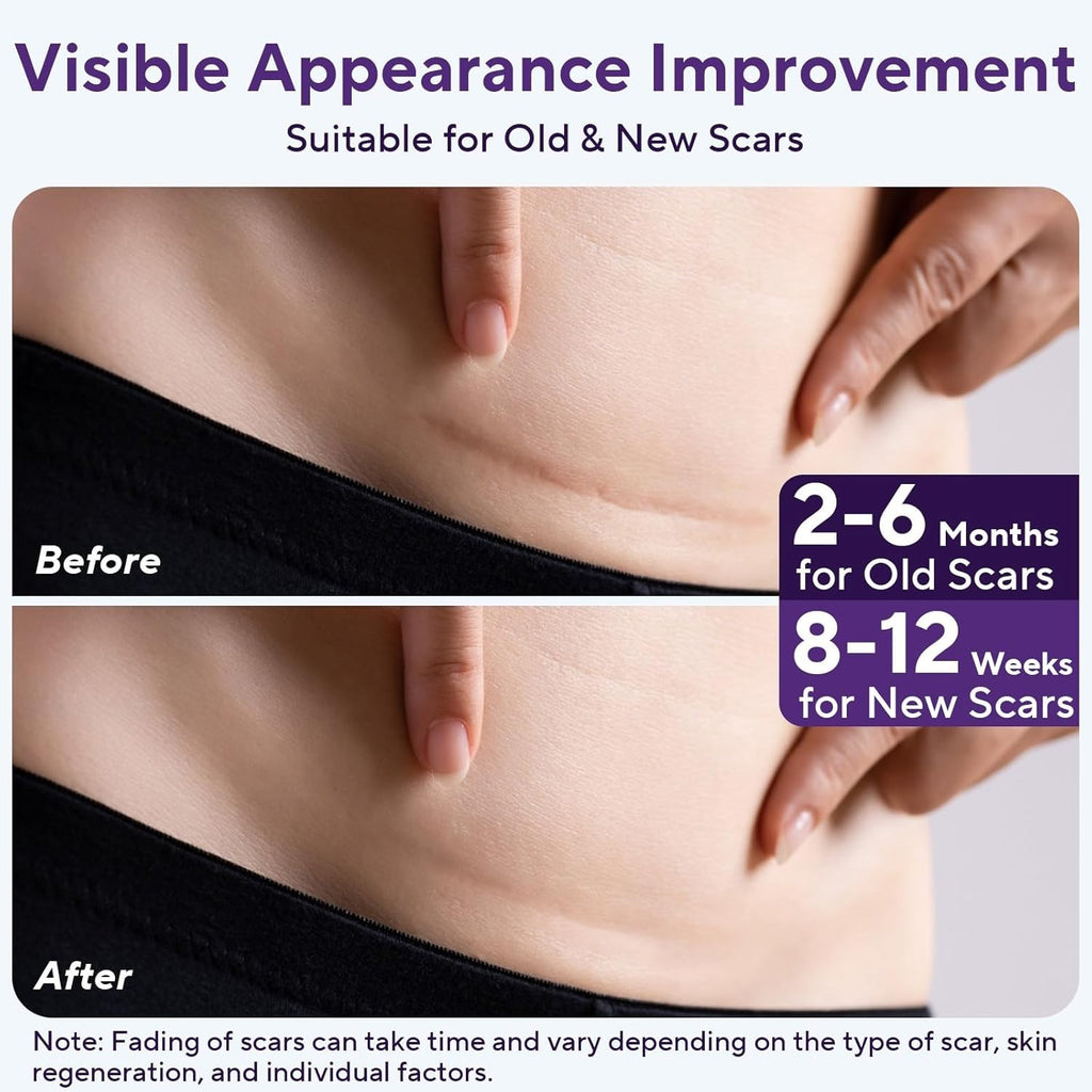 Silicone Scar Removal Tape for Hypertrophic Scars & Keloids - 1.6" x 60" Reusable Strip
