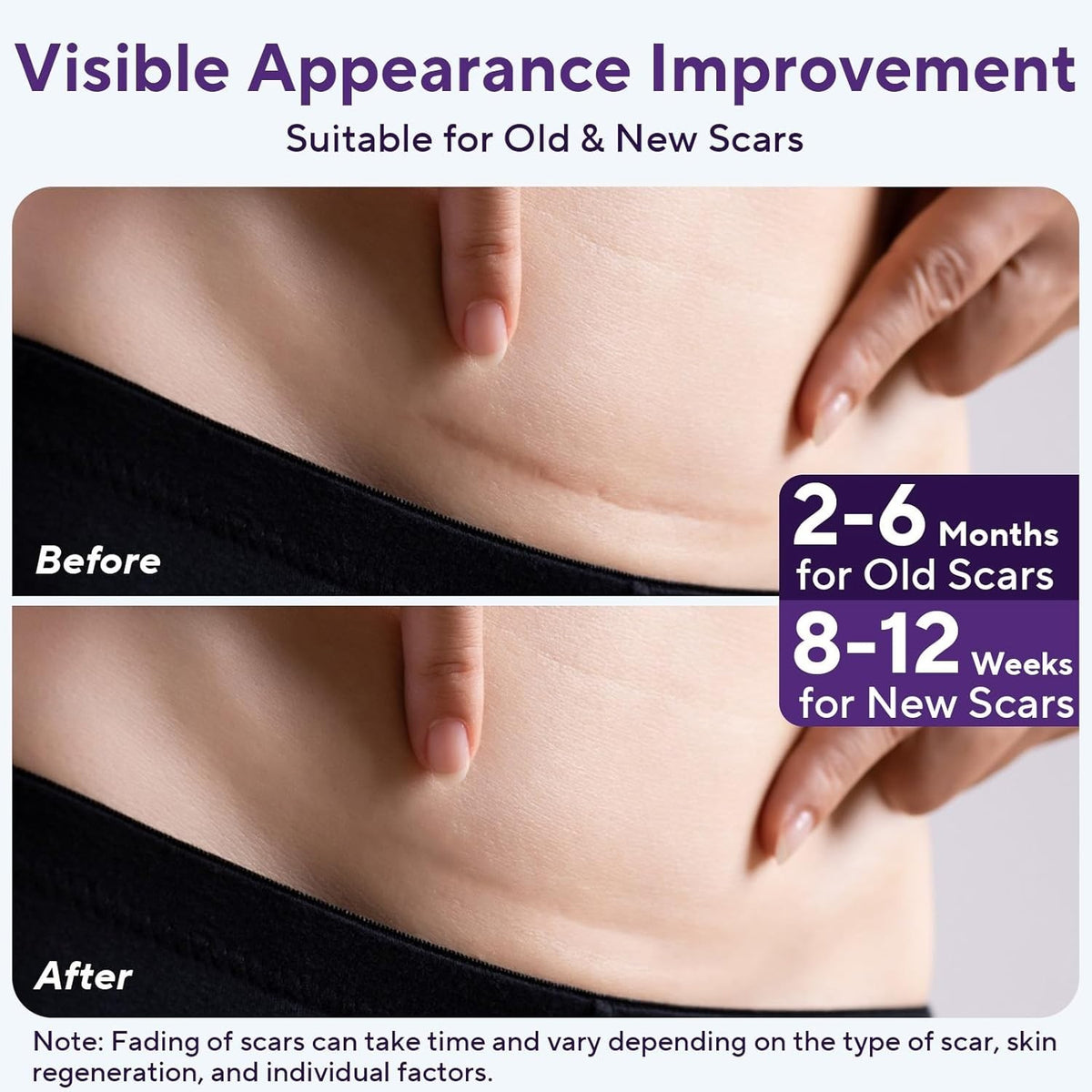 Silicone Scar Removal Tape for Hypertrophic Scars & Keloids - 1.6" x 60" Reusable Strip